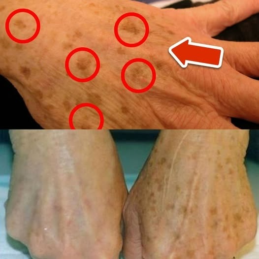 Najlepsza witamina usuwająca plamy starcze