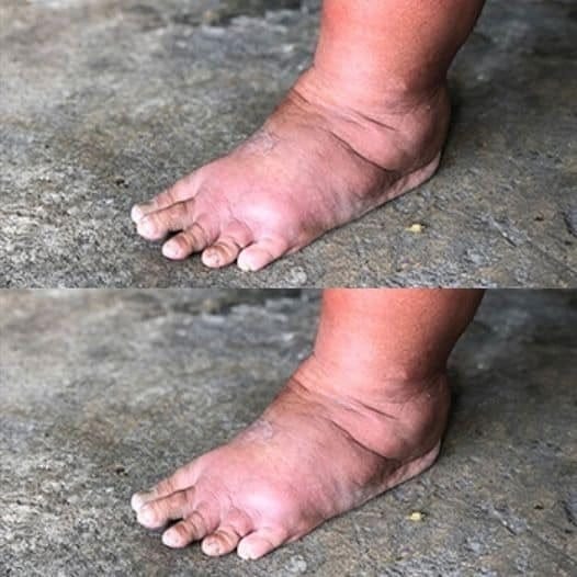 najważniejsza witamina eliminująca obrzęki rąk, nóg i stóp 🔴Usuwamy stąd nieaktywnych członków. Jeśli chcesz nadal otrzymywać nasze przepisy, daj nam znać.😀 Najpierw metoda (komentarz)💬👀.