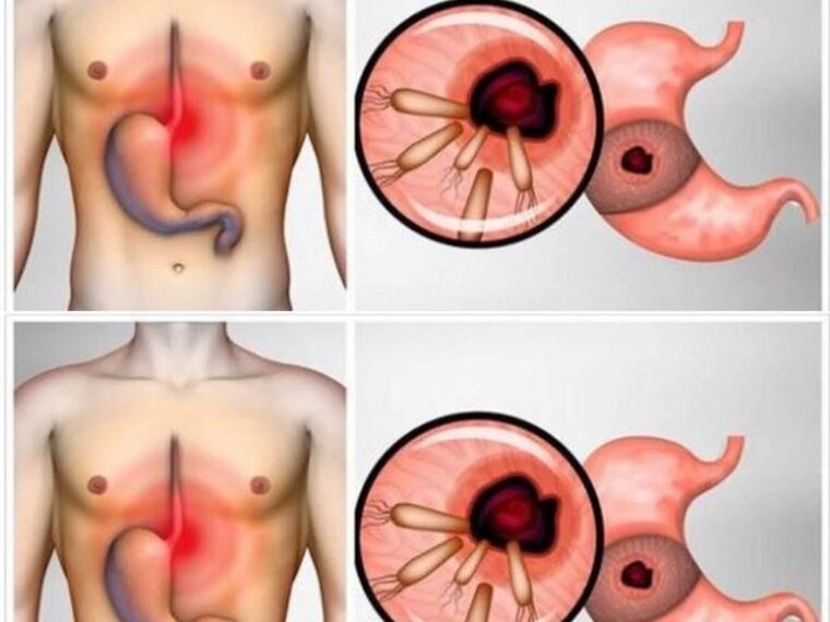 🔥🤢 Pożegnaj zgagę i wzdęcia! 🦠❌ Oto jak wyeliminować odpowiedzialne za to bakterie i przywrócić komfort trawienia. 🌿💪 Cała sztuczka tkwi w pierwszym komentarzu! ❤👇👇