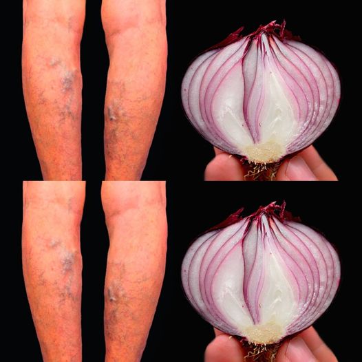 3 najlepsze naturalne sposoby leczenia żylaków