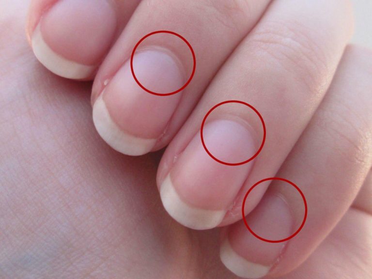 Co oznaczają białe plamki na paznokciach?