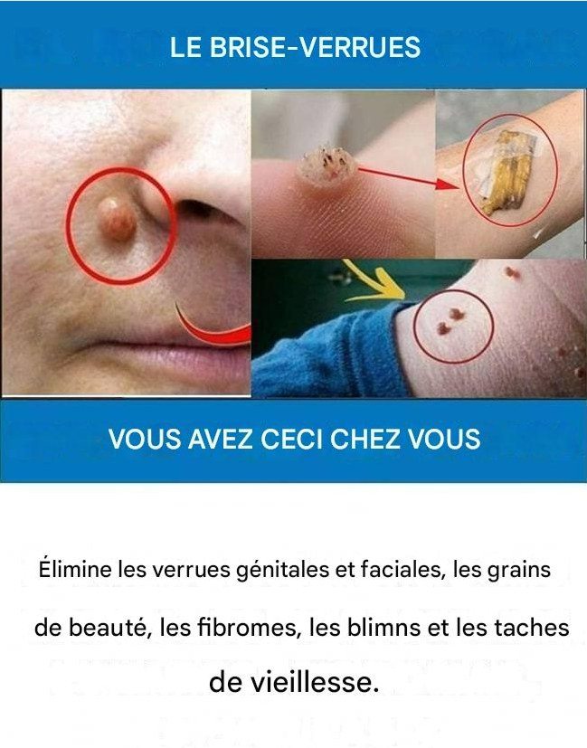 Naturalny środek na usuwanie brodawek