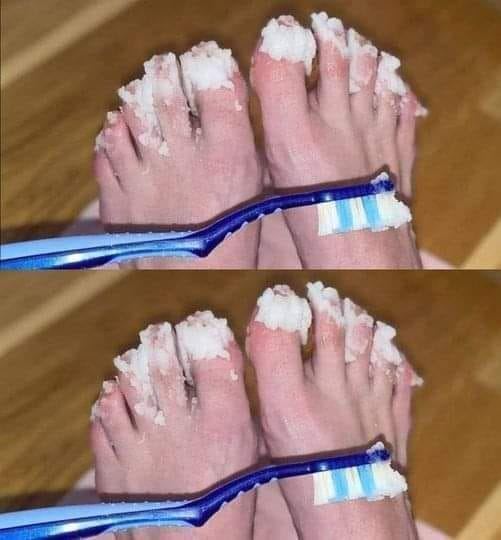 Naturalny środek na grzybicę paznokci: skuteczne leczenie zapewniające szybką ulgę