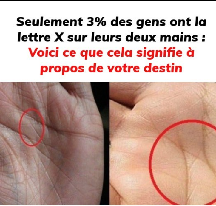 wiele do powiedzenia na temat naszej osobowości, naszej przyszłości, naszej sytuacji romantycznej i finansowej, a nawet naszego przeznaczenia. Praktykę czytania z dłoni nazywa się chiromancją. Podobnie jak odciski palców, każda dłoń jest wyjątkowa i niepowtarzalna, a nasza tożsamość może zostać zapisana na dłoni. W tym artykule odkryjemy, co kryje się za literą X, którą widnieje na dłoni 3% populacji świata. Czym jest chiromancja? Praktyka ta ma ponad 5000 lat i pochodzi z Indii. Następnie pojawiła się w Chinach, Tybecie, Egipcie, a do Europy dotarła w średniowieczu. Chiromancja jest uważana za sztukę, jednak jej historyczny rozwój nie pozwolił na uzyskanie statusu odrębnej dziedziny nauki, chociaż niektórzy naukowcy próbowali powiązać astrologię ze sztuką chiromancji. Celem chiromancji jest przewidywanie przyszłości poprzez odczytywanie i interpretowanie każdej linii na dłoni. Jak czytać z dłoni?  Więcej informacji znajdziesz na następnej stronie