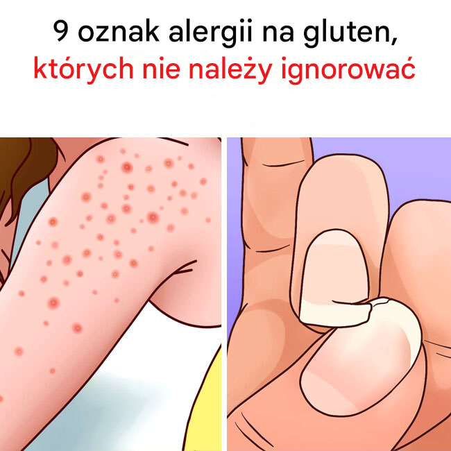 ⚠️🌾 9 oznak, które mogą wskazywać na alergię na gluten! 😲❌ Zmęczenie, problemy trawienne, bóle głowy… A co jeśli to nietolerancja? 🤔💡 Wszystkie objawy znajdziesz w pierwszym komentarzu! ❤👇👇