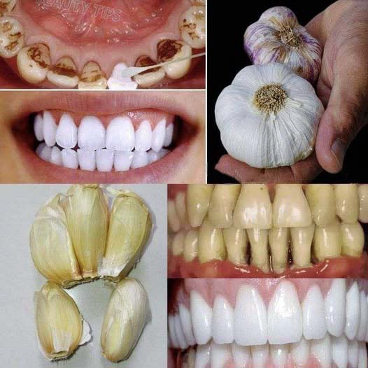 Tajni dentyści, których nie chcesz, abyś wiedział: usuń kamień nazębny i wybiel zęby w zaledwie 2 minuty za pomocą czosnku ‎‎