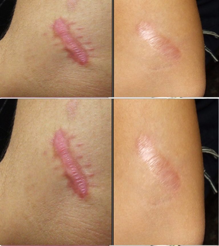 10 naturalnych środków na pozbycie się keloidów