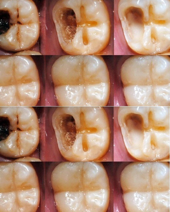 Jak naturalnie wyleczyć próchnicę. Pamiętaj o tych wskazówkach, aby uniknąć wizyty u dentysty