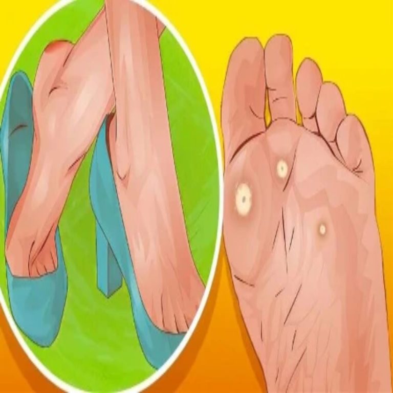 ODCISKI NA STÓPACH OTO 4 ROŚLINY, KTÓRE POZWOLĄ SIĘ ICH POZBYĆ