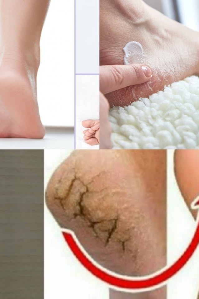 Ta naturalna sztuczka pomoże Ci zwalczyć pęknięte pięty w ciągu nocy