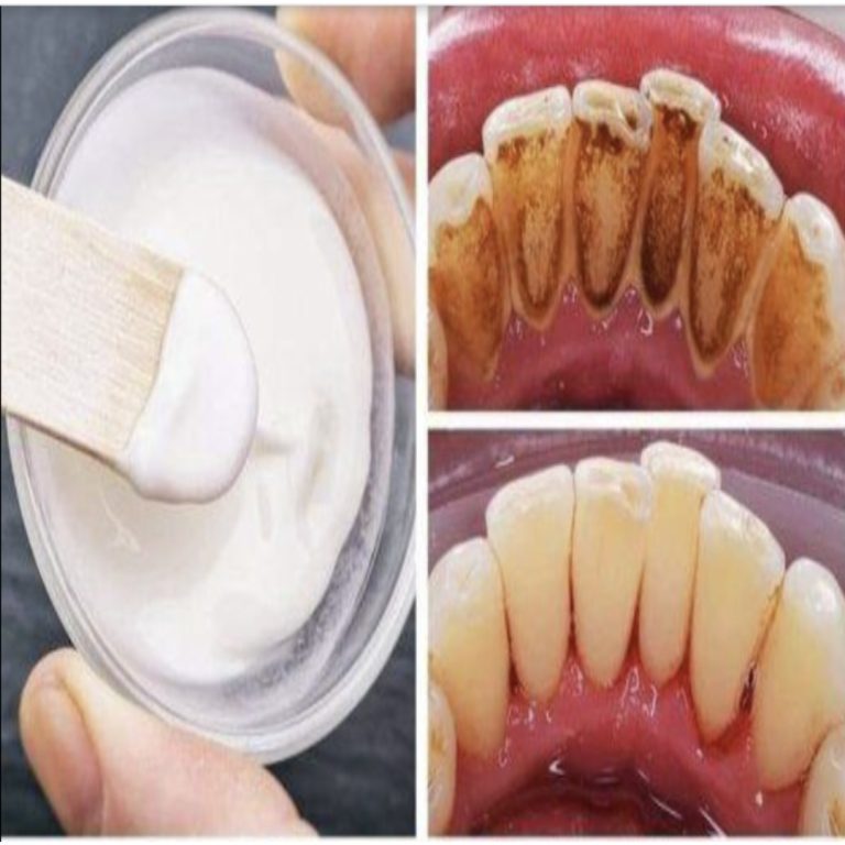 Odkryj moc sody oczyszczonej dla optymalnego zdrowia jamy ustnej