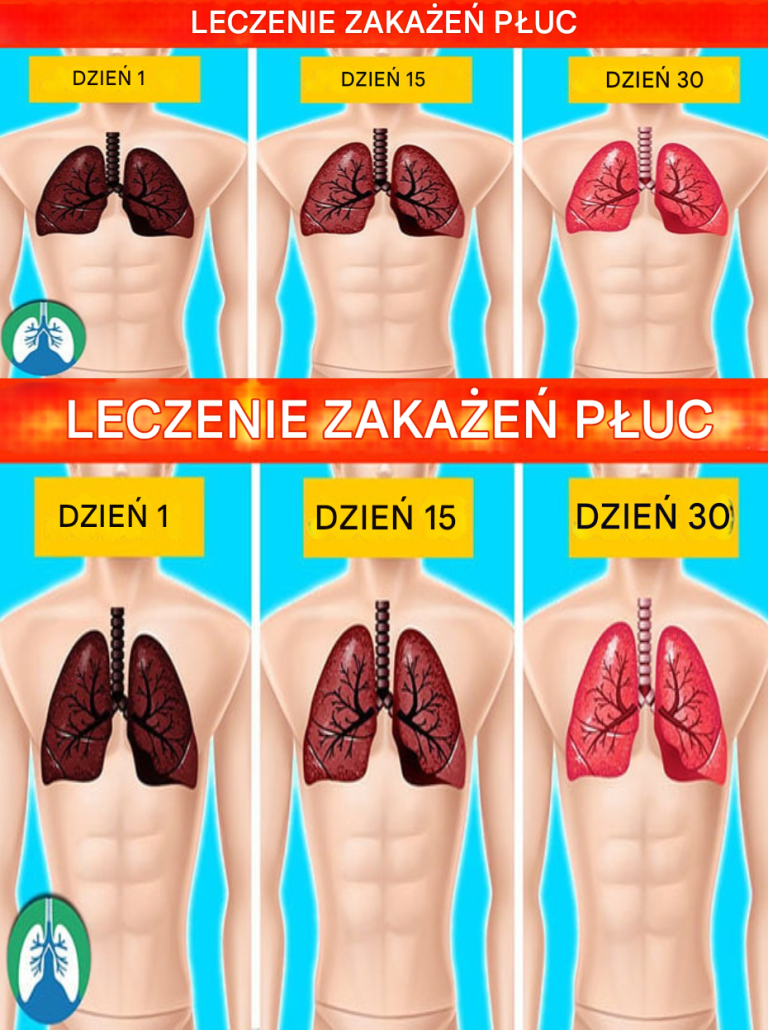 6 naturalnych sposobów leczenia infekcji płuc (domowe sposoby)