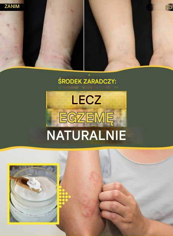 8 naturalnych środków na egzemę i wysypkę
