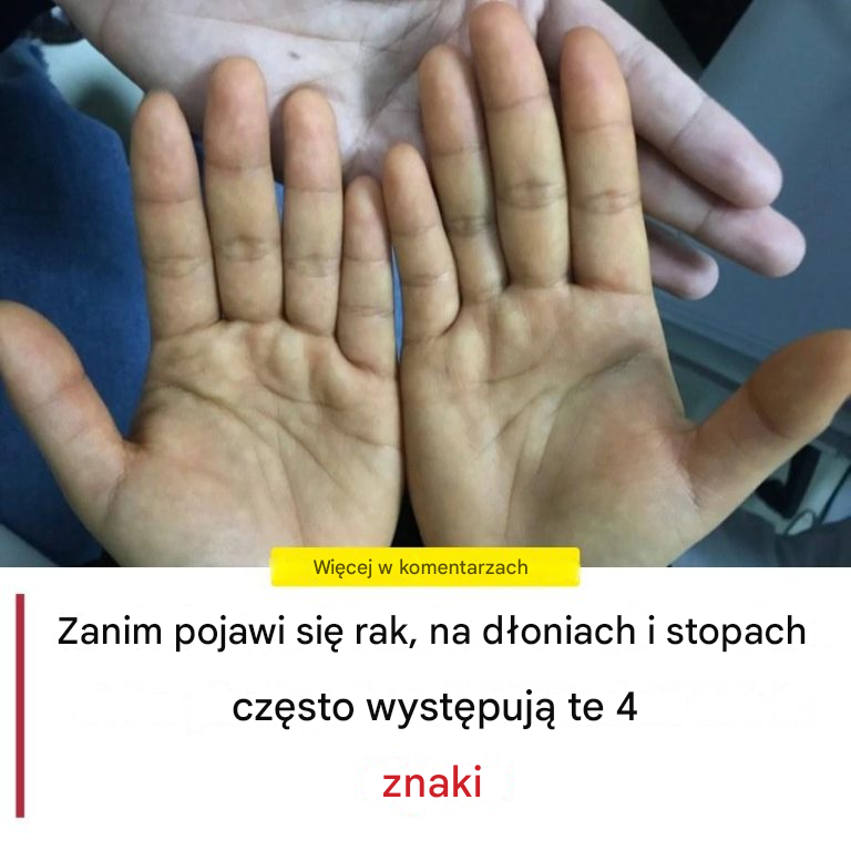 Zanim pojawi się rak, dłonie i stopy często wykazują te 4 objawy