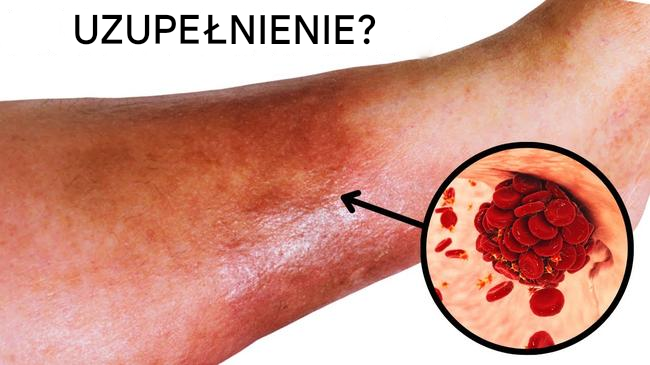Jedna łyżka stołowa dziennie i skrzepy krwi znikną na zawsze!