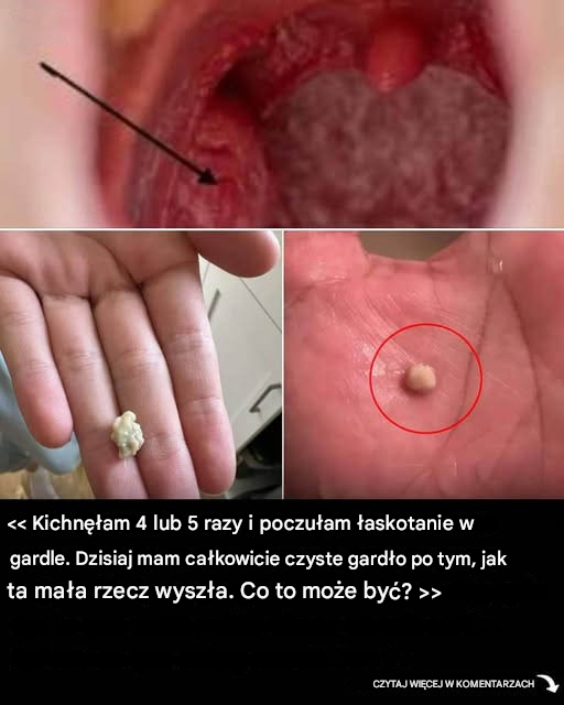 Oto, co musisz wiedzieć o kamieniach migdałkowych