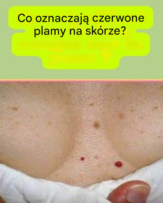Petechiae: Co Twoje małe czerwone plamki mówią o Twoim zdrowiu