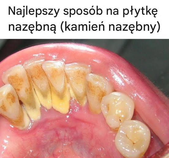 Najlepszy sposób na płytkę nazębną (kamień nazębny)