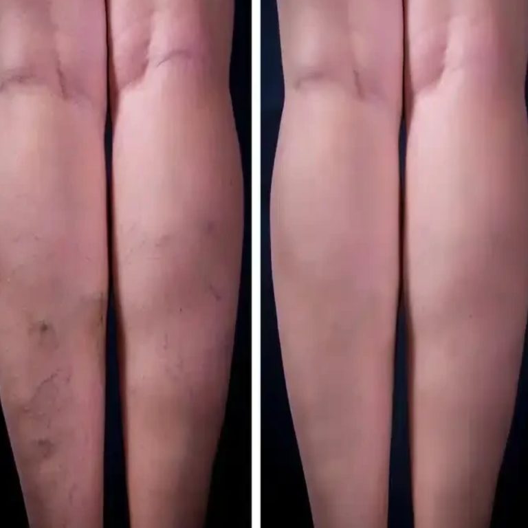 mało znana babcia na żylaki