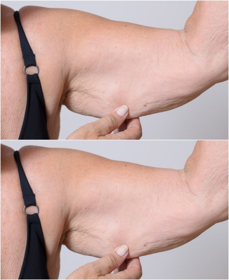 Osłabienie mięśni u osób starszych nazywa się sarkopenią. Jak możemy zapobiec tragicznym konsekwencjom?