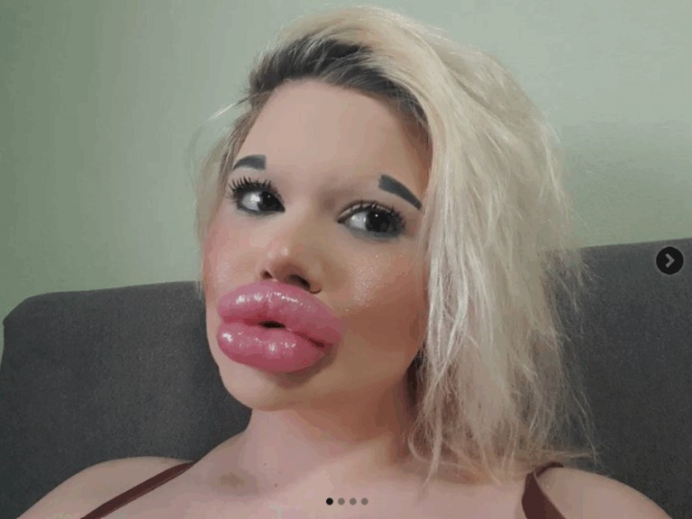 ANDREA PRZESZŁA PONAD 20 OPERACJI POWIĘKSZANIA UST, BY OSIĄGNĄĆ NAJWIĘKSZĄ NA ŚWIECIE KACZĄ TWARZ