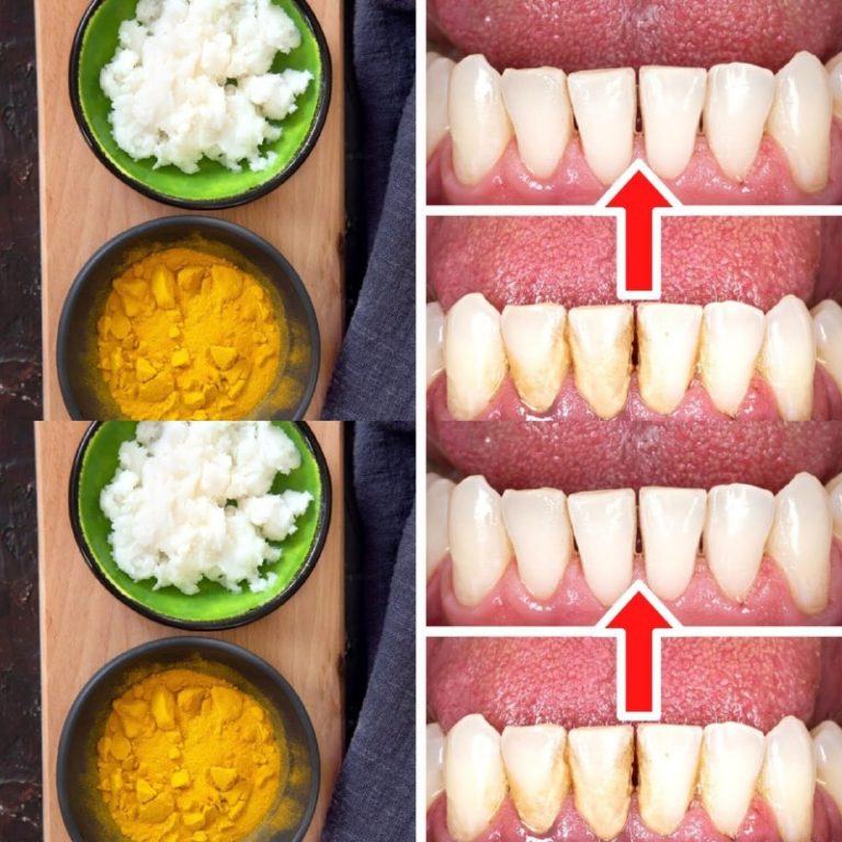 Naturalne czyszczenie zębów: jak usunąć kamień nazębny bez dentysty za pomocą kurkumy i soli