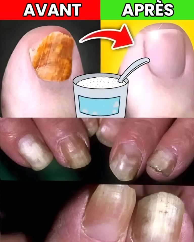 Jak naturalnie pozbyć się grzybicy paznokci?