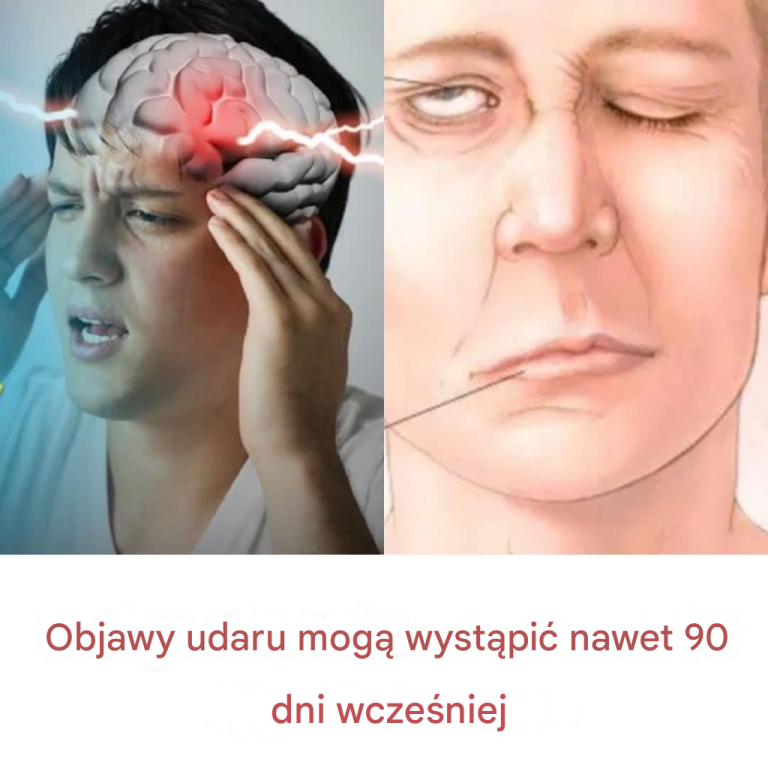 Objawy udaru mogą wystąpić nawet 90 dni wcześniej