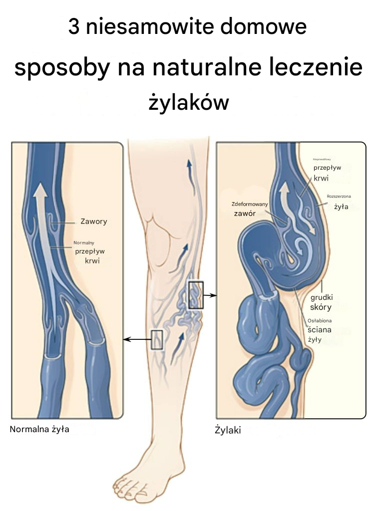 3 niesamowite domowe sposoby na naturalne leczenie żylaków