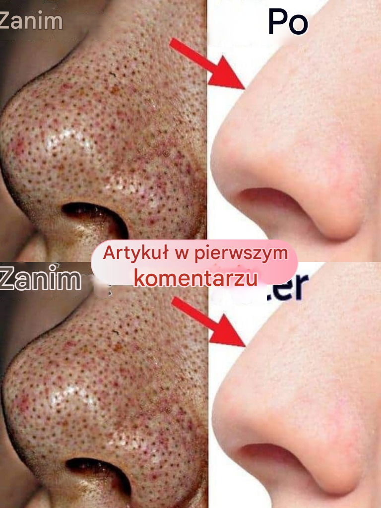 Jak pozbyć się zaskórników w kilka minut? 3 proste i skuteczne wskazówki