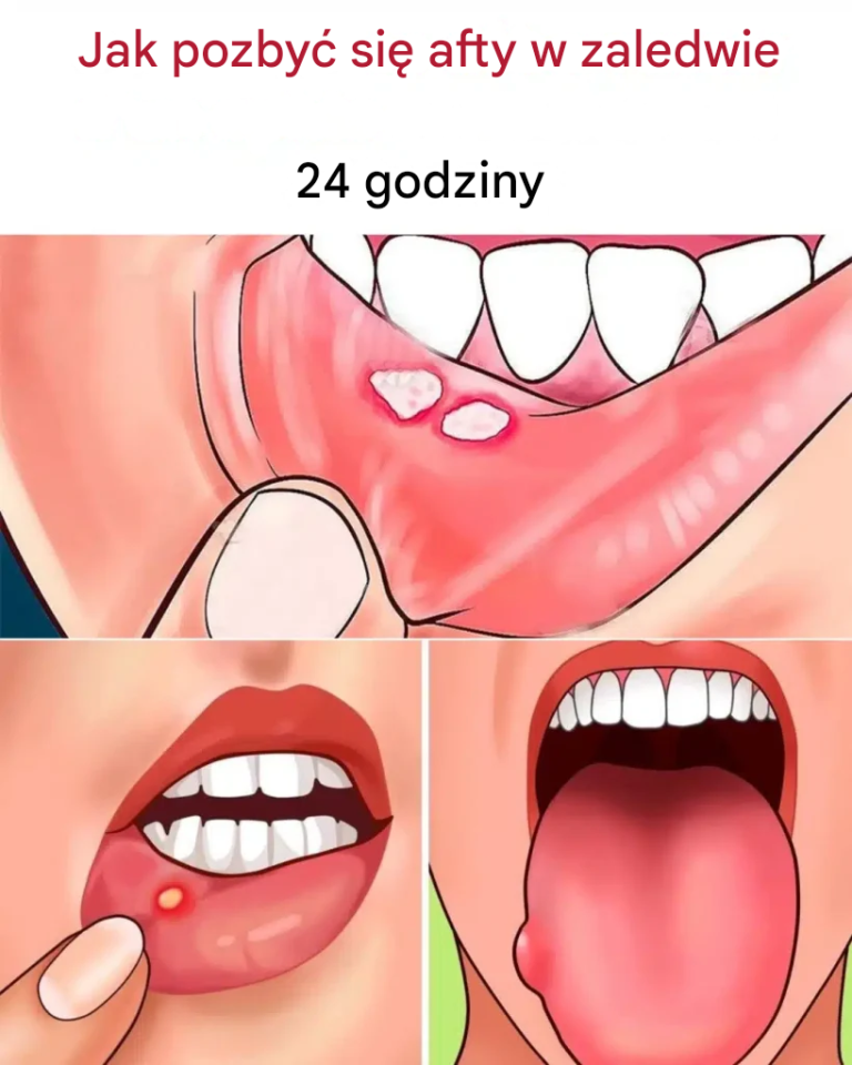 Jak pozbyć się afty w zaledwie 24 godziny