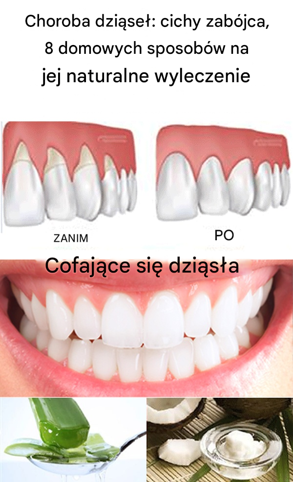 Choroba dziąseł: cichy zabójca, 8 domowych sposobów na jej naturalne wyleczenie