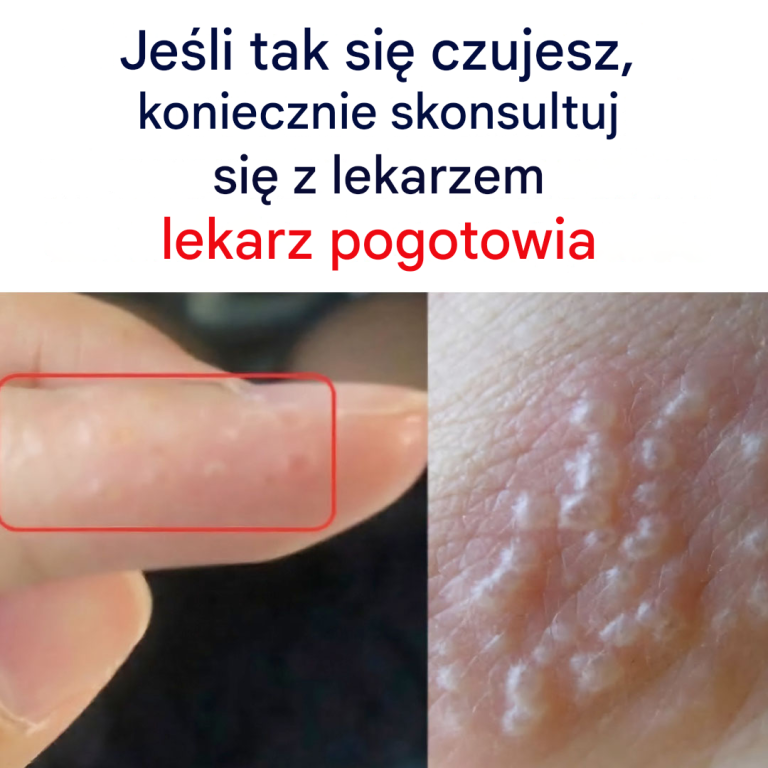 Jeśli zauważysz te czerwone i bolesne grudki, możesz cierpieć na tę chorobę.