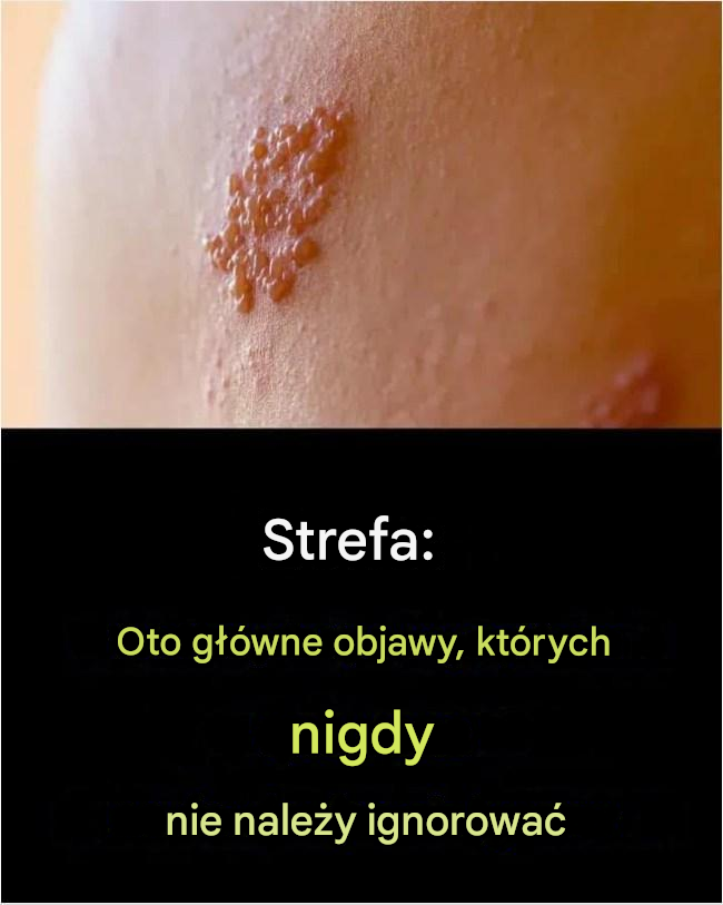 Półpasiec: objawy, powikłania i profilaktyka