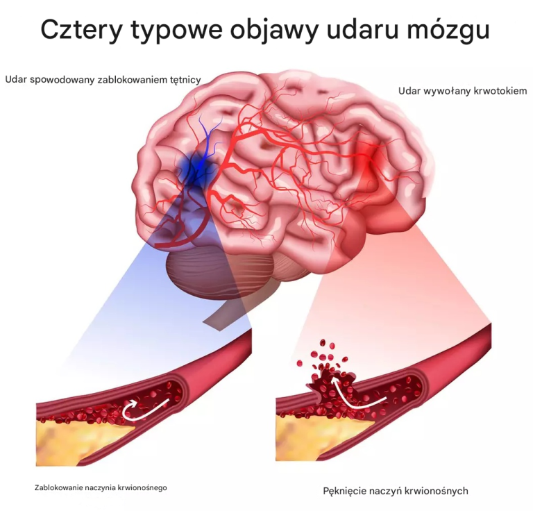 Cztery typowe objawy udaru mózgu