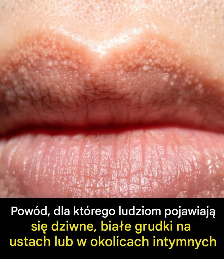 Przyczyny pojawiania się „białych grudek” na ustach i innych częściach ciała