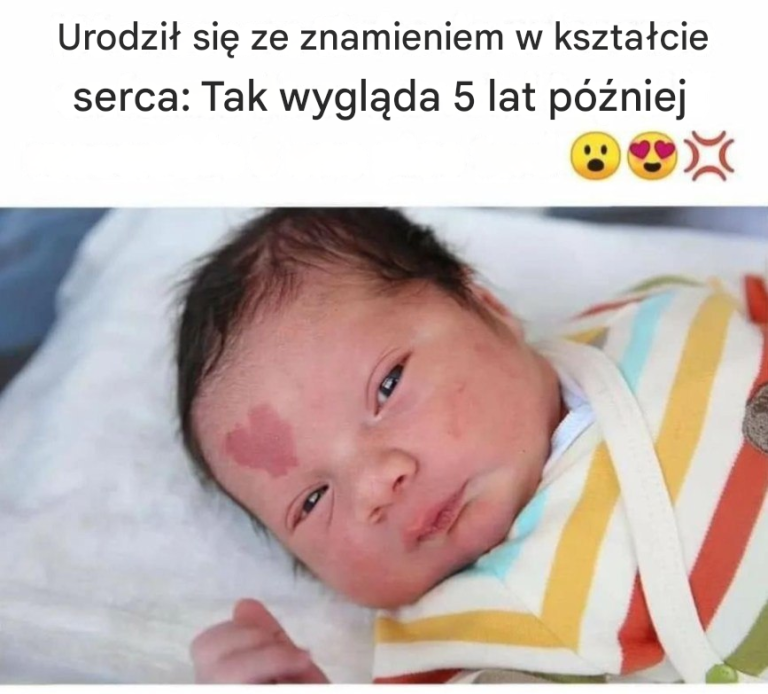 Znamię: kolor, kształt... Odpowiedzi na najczęściej zadawane pytania