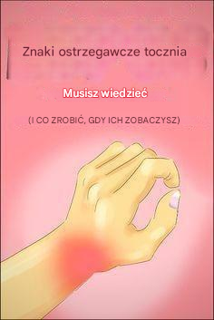 Rozpoznawanie sygnałów ostrzegawczych: 8 wczesnych objawów tocznia