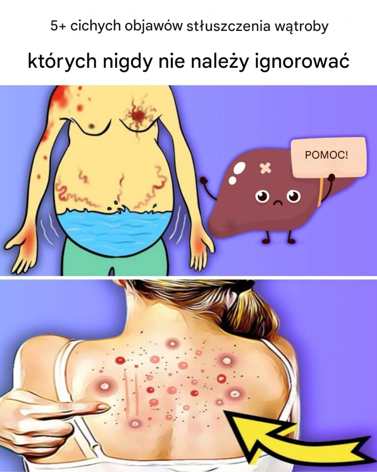 Stłuszczenie wątroby: przyczyny, objawy, leczenie i domowe sposoby