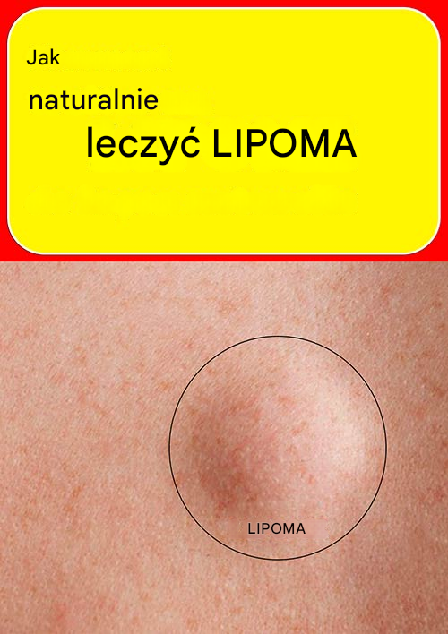 Jak leczyć tłuszczaka naturalnie
