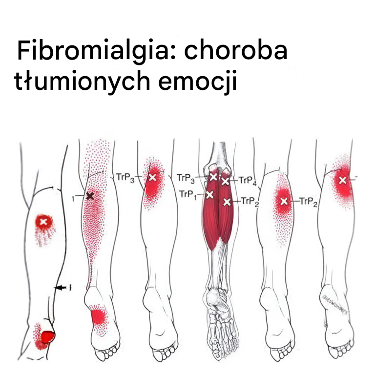 Jaki jest związek pomiędzy fibromialgią a emocjami?