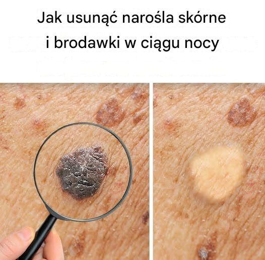 Jak usunąć narośla skórne i brodawki w ciągu nocy